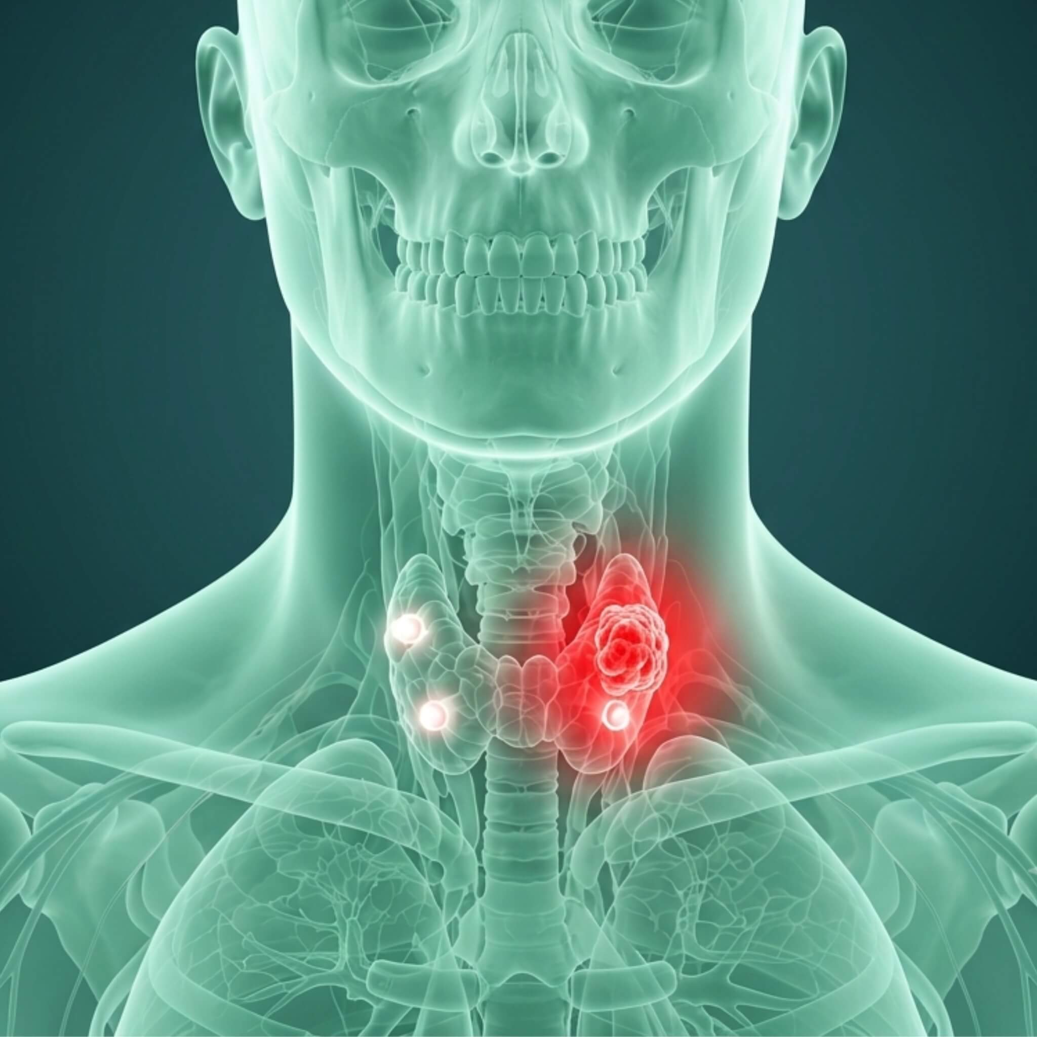 Parathyroid Tumors - About